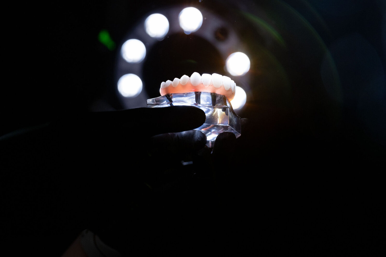 Full-arch dental implant prosthesis