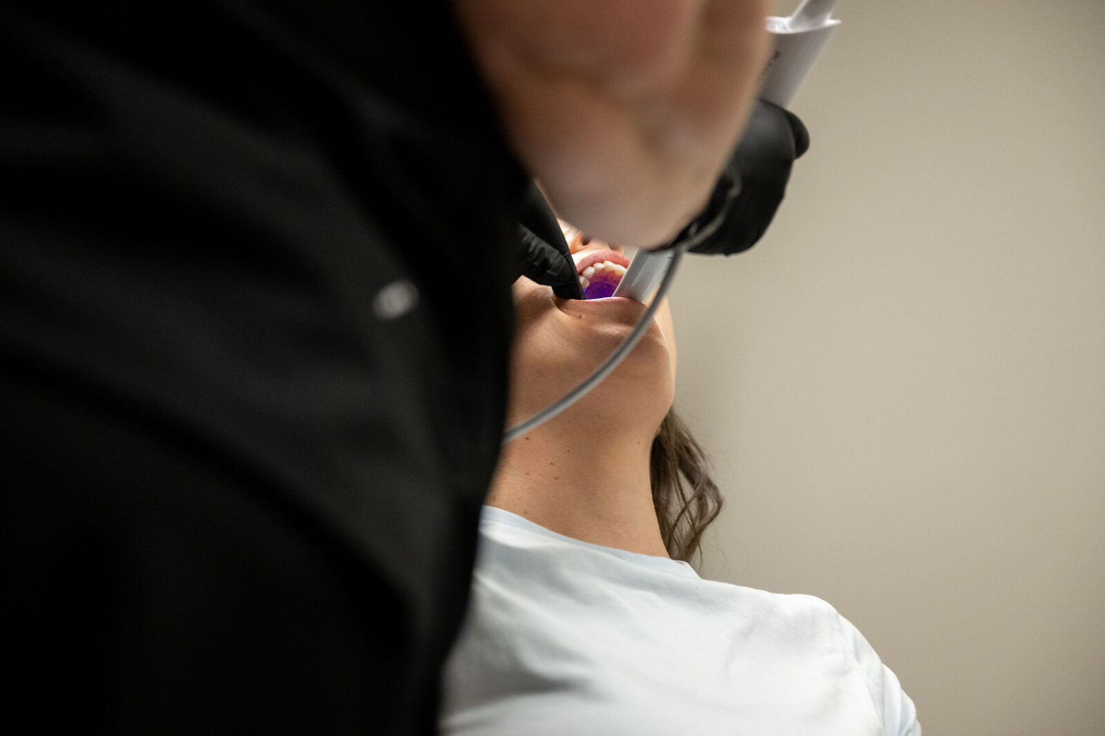 Recovery after AlloDerm grafting